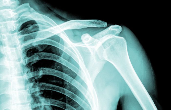 Shoulder X-Ray